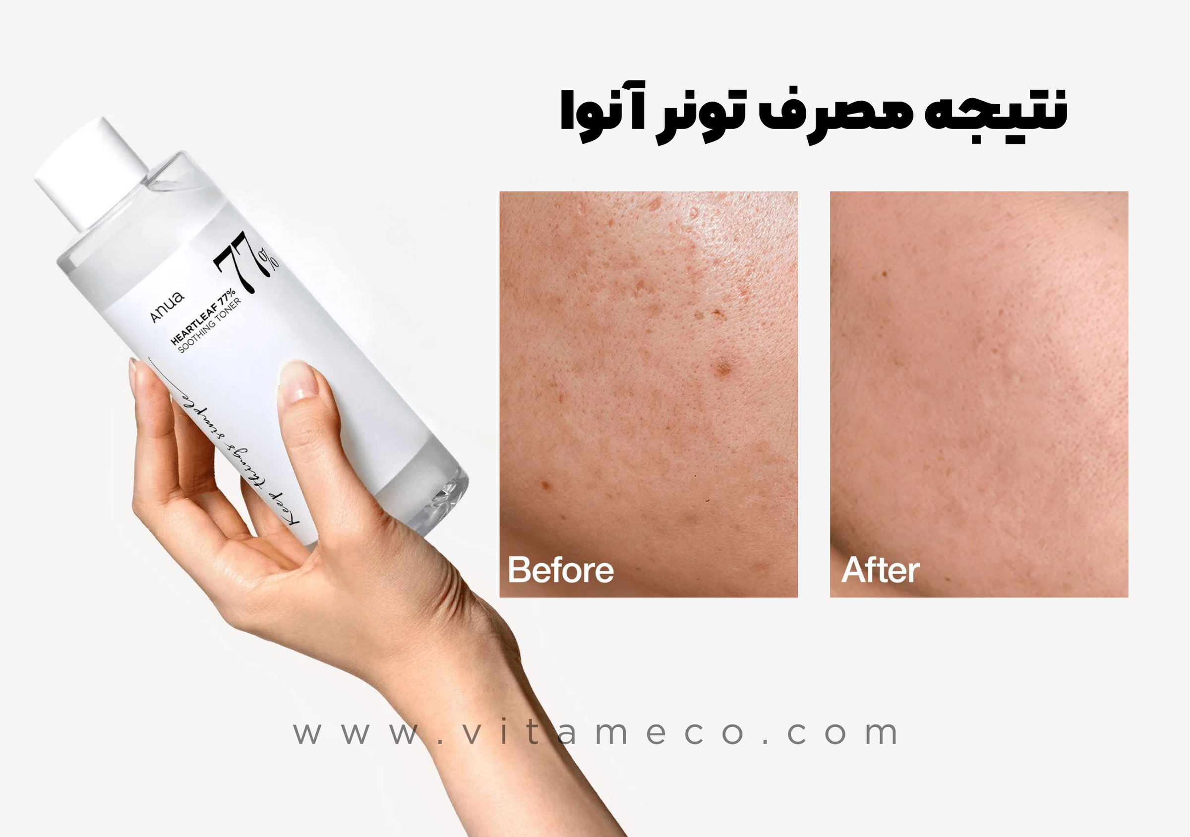 تونر_التیام_بخش_آنوا