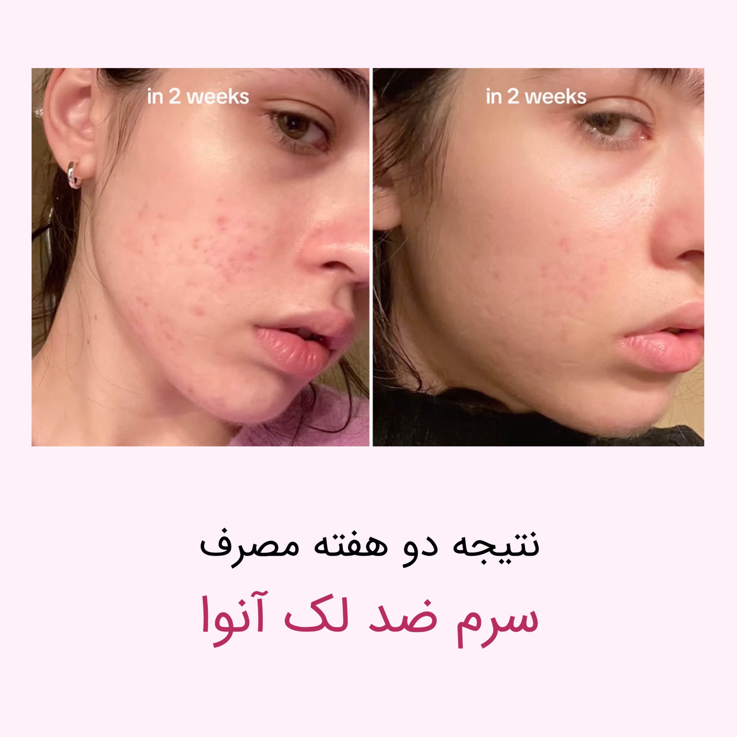 سرم نیاسینامید آنوا