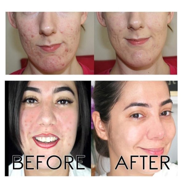 سرم لایه بردار پیلینگ اوردینری The ordinary AHA BHA Peeling solution حجم 30 میل - Image 4