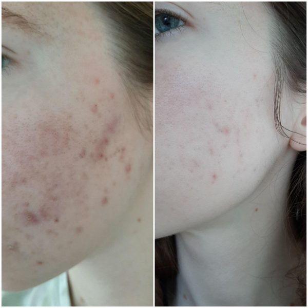 سرم لایه بردار پیلینگ اوردینری The ordinary AHA BHA Peeling solution حجم 30 میل - Image 2