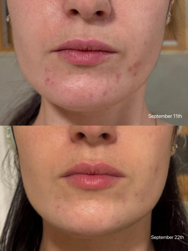 سرم میکرونیدلینگ ریدل شات 100 Vt Cosmetics حجم ۵۰ میل - Image 3