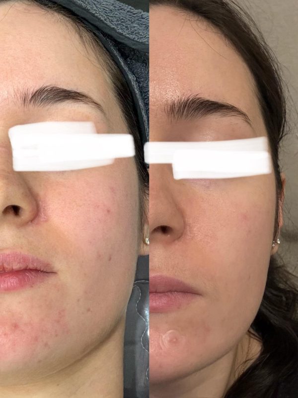 سرم میکرونیدلینگ ریدل شات 100 Vt Cosmetics حجم ۵۰ میل - Image 2